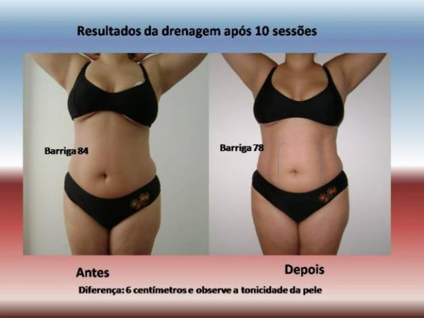 Drenagem línfatica